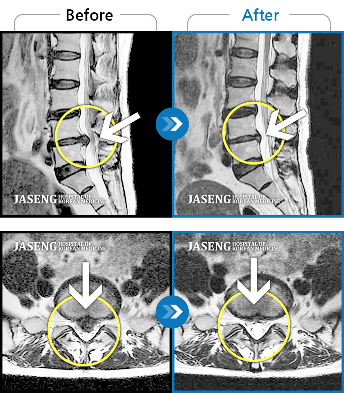 Ȼڻѹ溴 ġ MRI  ġ- 㸮 ٸ     ٷ ϰ Ÿ ϰ  Ͽϴ.