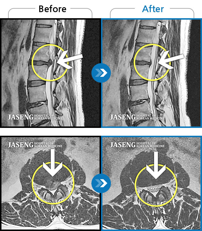 Ȼڻѹ溴 ġ MRI  ġ-㸮 θ  ٸ     㸮    . 