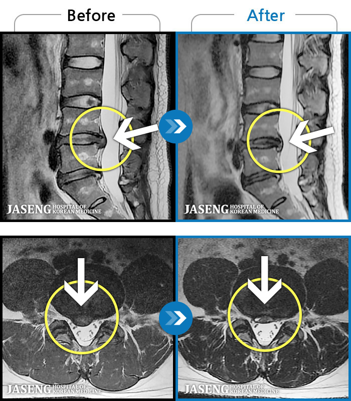 �Ȼ��ڻ��ѹ溴�� ġ���� MRI�� ���� ġ����-���� �㸮 �������� ����