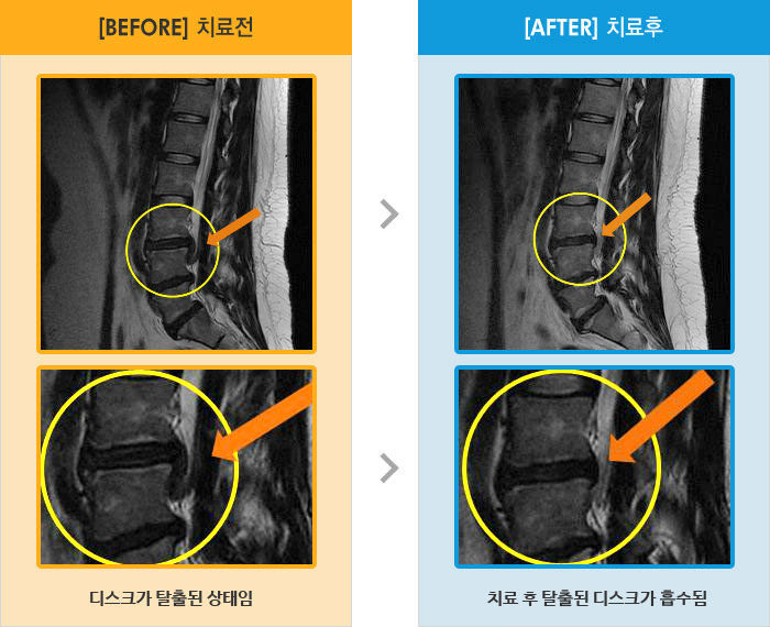 자생한방병원 치료사례 MRI로 보는 치료결과-허리통증과 왼쪽 다리 전체 방사통