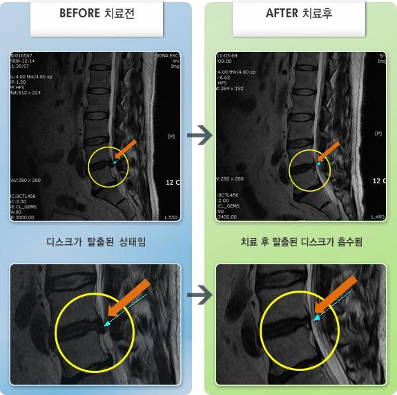 목동자생한방병원 치료 전후 MRI 비교 이미지