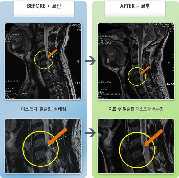 목동자생한방병원 치료 전후 MRI 비교 이미지