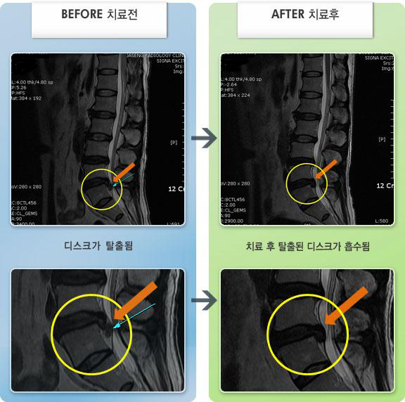 목동자생한방병원 치료 전후 MRI 비교 이미지
