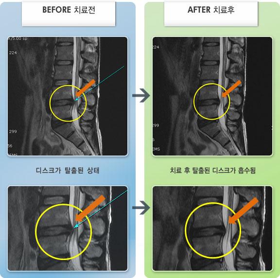 노원자생한방병원 치료 전후 MRI 비교 이미지