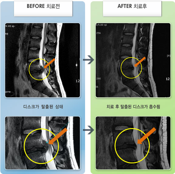 자생한방병원 치료 전후 MRI 비교 이미지