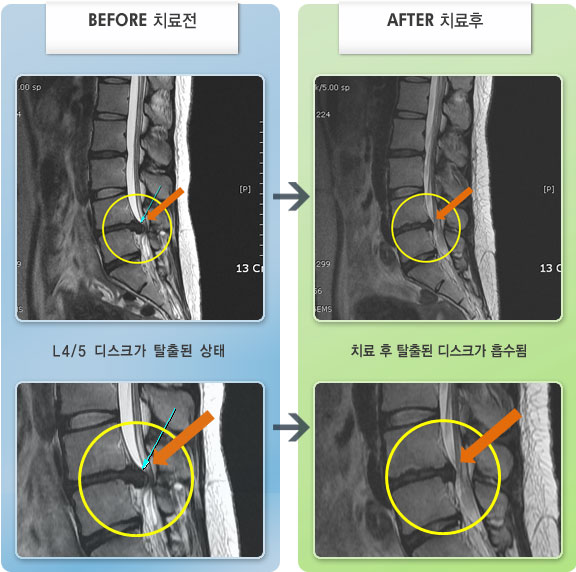 노원자생한방병원 치료 전후 MRI 비교 이미지