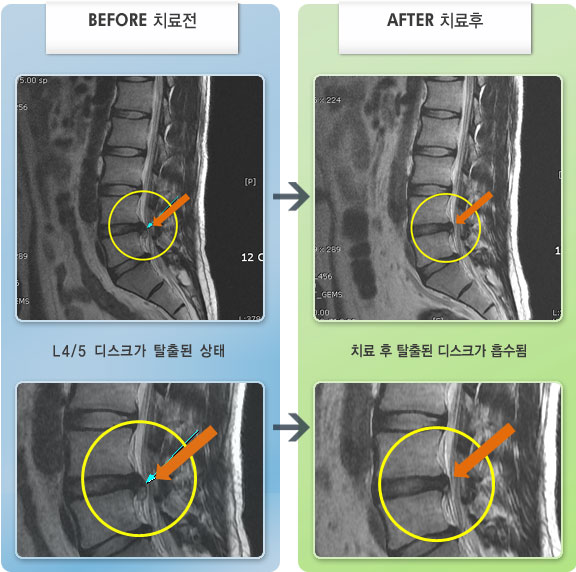 수원자생한방병원 치료 전후 MRI 비교 이미지