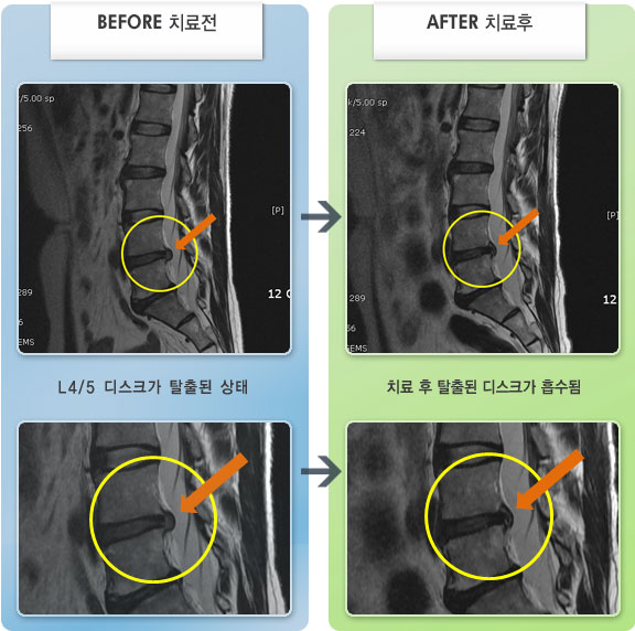 수원자생한방병원 치료 전후 MRI 비교 이미지