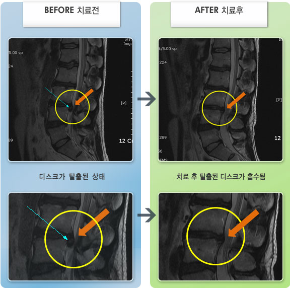 수원자생한방병원 치료 전후 MRI 비교 이미지