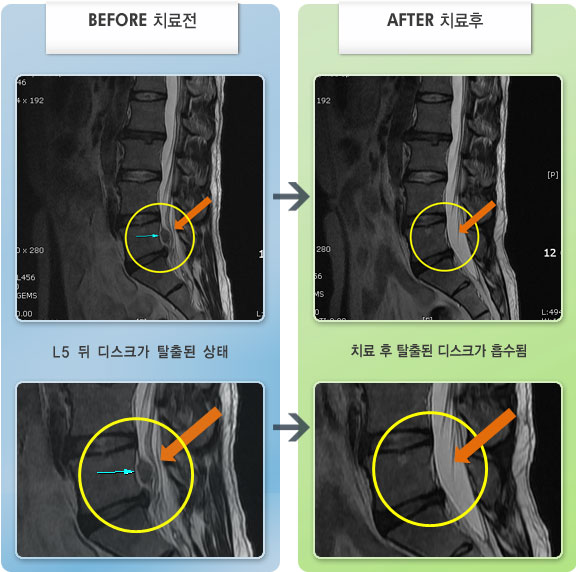 목동자생한방병원 치료 전후 MRI 비교 이미지