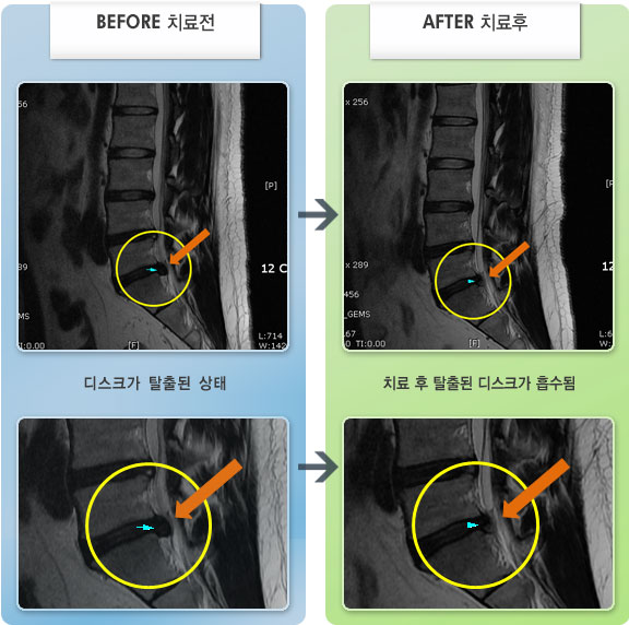 수원자생한방병원 치료 전후 MRI 비교 이미지
