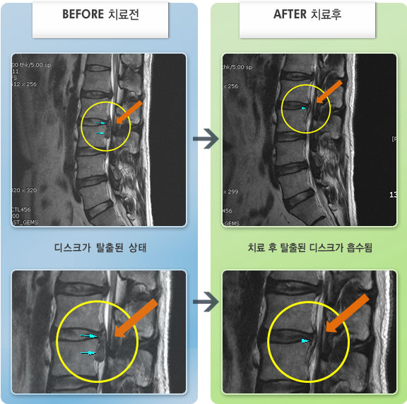 자생한방병원 치료사례 MRI로 보는 치료결과-기립시, 자세변경시 통증이 증가하는 상태