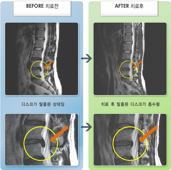 자생한방병원 치료사례 MRI로 보는 치료결과-허리 통증이 심하여 굽히지 못하고 움직임이 제한된 상태