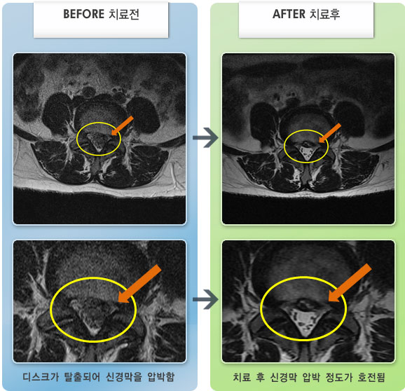 자생한방병원 치료사례 MRI로 보는 치료결과-허리 통증이 심하며 요부 굴곡 시, 앉았다 일어날 때 통증이 증가