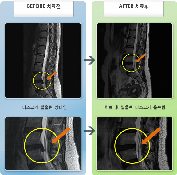 자생한방병원 치료사례 MRI로 보는 치료결과-허리디스크로 인한 하지 통증 및 저림