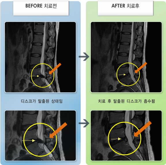 자생한방병원 치료사례 MRI로 보는 치료결과-허리와 엉치, 우측 다리 통증