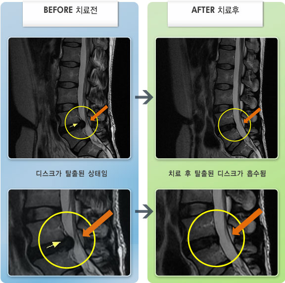자생한방병원 치료사례 MRI로 보는 치료결과-허리디스크로 인한 양쪽 엉치 및 다리, 발바닥 통증