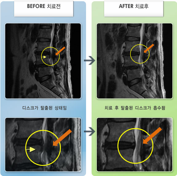 자생한방병원 치료사례 MRI로 보는 치료결과-허리 통증과 왼쪽 엉치에서 종아리, 발목까지 통증이 심하였다.