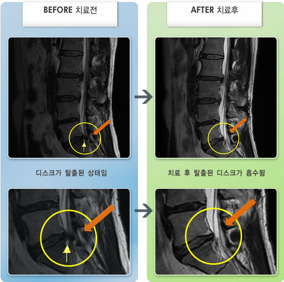 자생한방병원 치료사례 MRI로 보는 치료결과-허리 통증과 왼쪽 엉치부터 종아리까지 통증