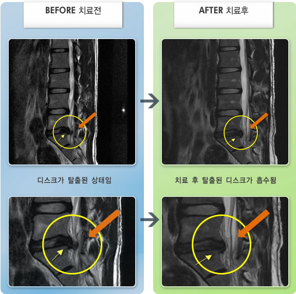 자생한방병원 치료사례 MRI로 보는 치료결과-왼쪽 엉치 통증이 심하고 오래 걸으면 다리가 당김