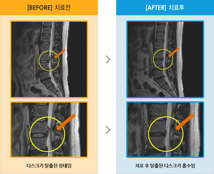 자생한방병원 치료사례 MRI로 보는 치료결과-우측 허리와 엉치 쑤시는 통증