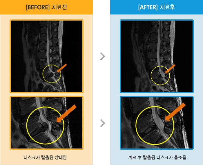 자생한방병원 치료사례 MRI로 보는 치료결과-왼쪽 종아리, 발 저림과 엉치 눌리는듯한 통증