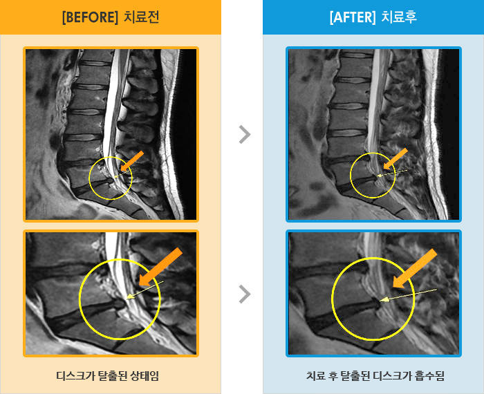 자생한방병원 치료사례 MRI로 보는 치료결과-허리 통증이 심함