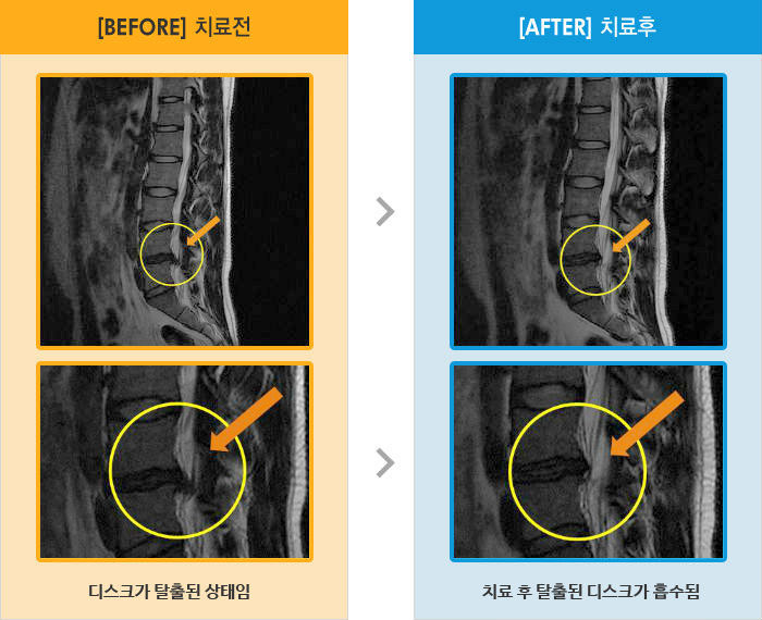 자생한방병원 치료사례 MRI로 보는 치료결과-왼쪽 허리와 엉치 통증