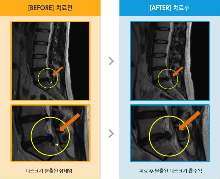자생한방병원 치료사례 MRI로 보는 치료결과-허리와 왼쪽 다리 통증