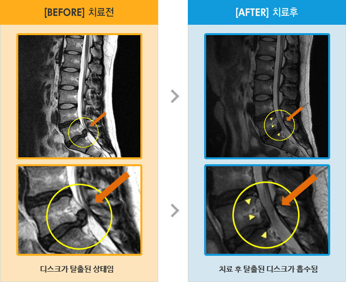 자생한방병원 치료사례 MRI로 보는 치료결과-허리 통증으로 누웠다 일어날 때 일어나기가 힘듬