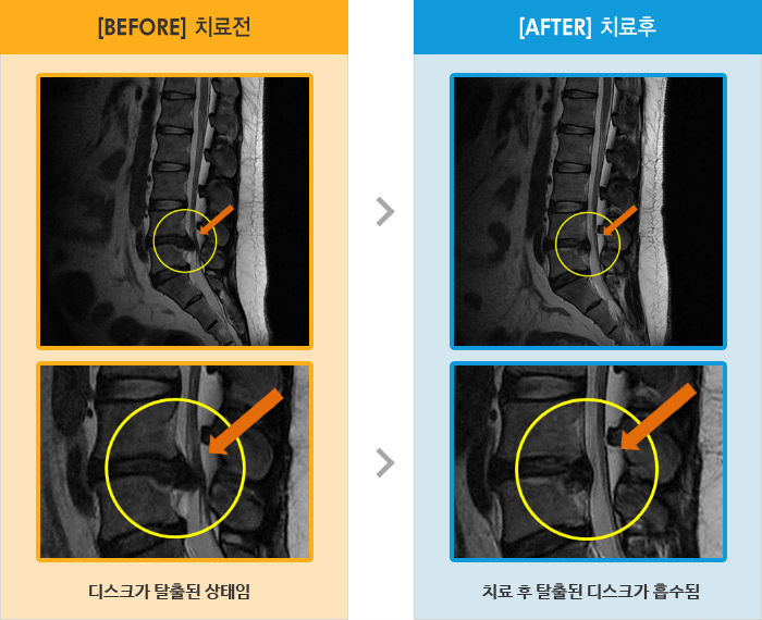 자생한방병원 치료사례 MRI로 보는 치료결과-허리와 왼쪽 엉덩이,허벅지 통증