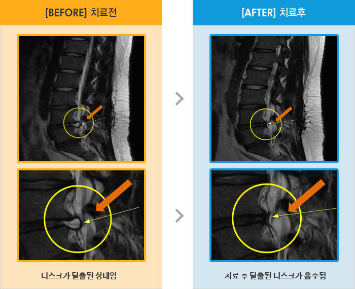 자생한방병원 치료사례 MRI로 보는 치료결과-허리와 오른쪽 다리 통증으로 오래 앉아있거나 누워서 움직여도 아픔