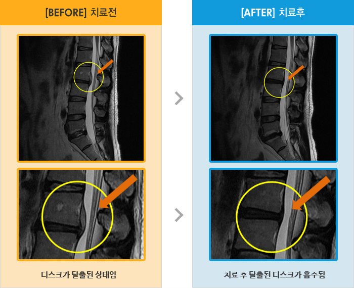 자생한방병원 치료사례 MRI로 보는 치료결과-한 자세를 오래하다 자세를 바꾸면 허리 통증
