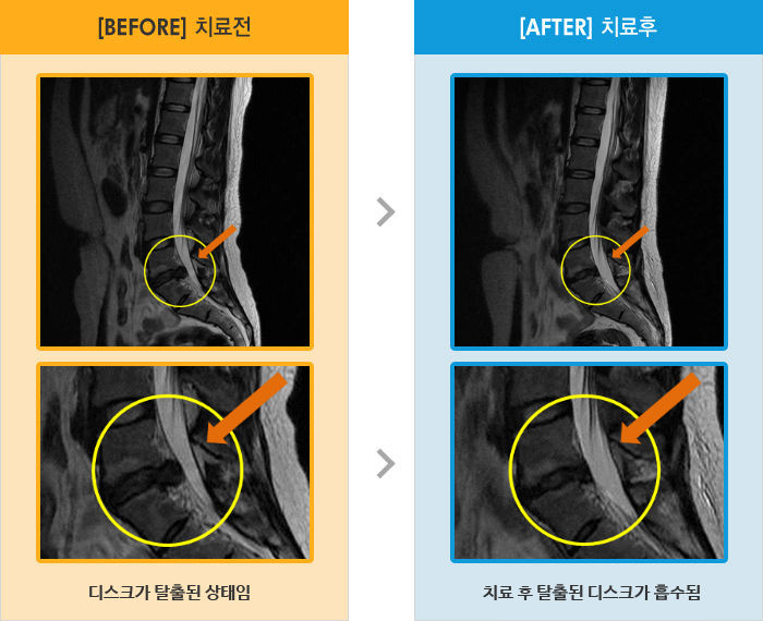 자생한방병원 치료사례 MRI로 보는 치료결과-허리와 오른쪽 엉덩이 통증 및 다리 저림