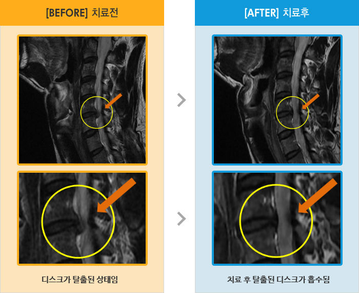 자생한방병원 치료사례 MRI로 보는 치료결과-목과 왼쪽 어깨 통증