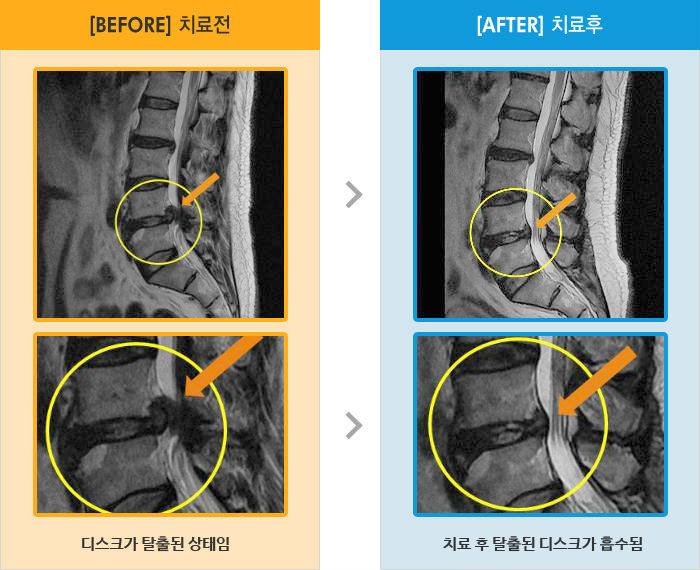 자생한방병원 치료사례 MRI로 보는 치료결과-다리 뒤쪽, 움직일 시 통증