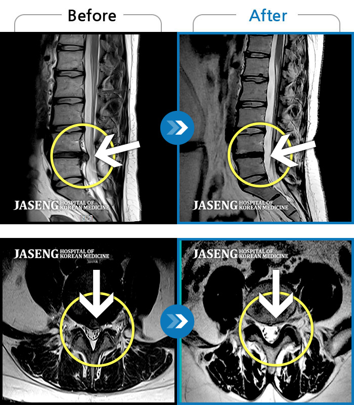 해운대자생한방병원 치료 전후 MRI 비교 이미지