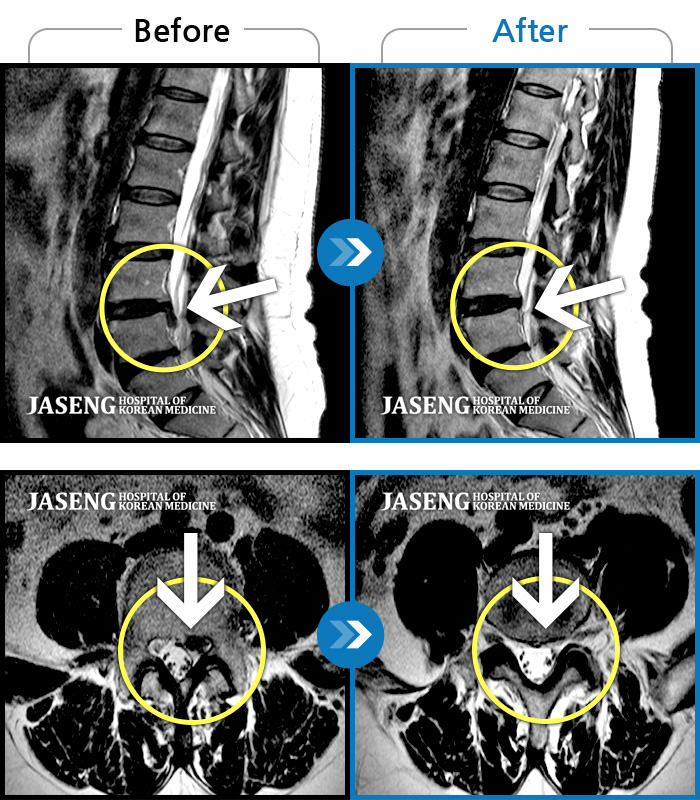 해운대자생한방병원 치료 전후 MRI 비교 이미지