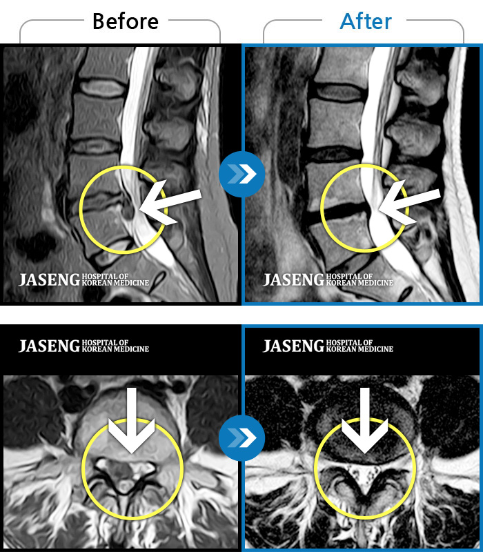 천안자생한방병원 치료 전후 MRI 비교 이미지