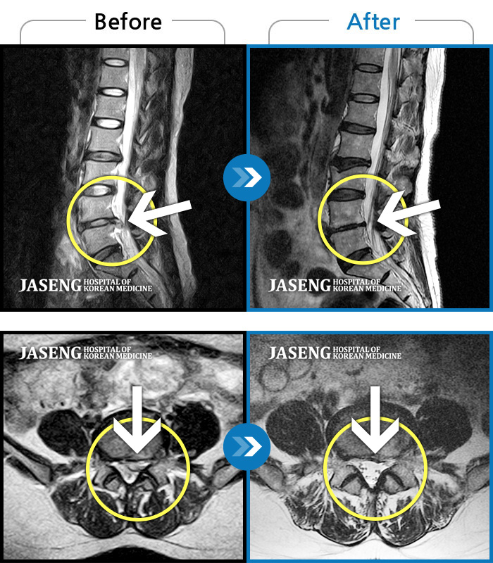 수원자생한방병원 치료 전후 MRI 비교 이미지