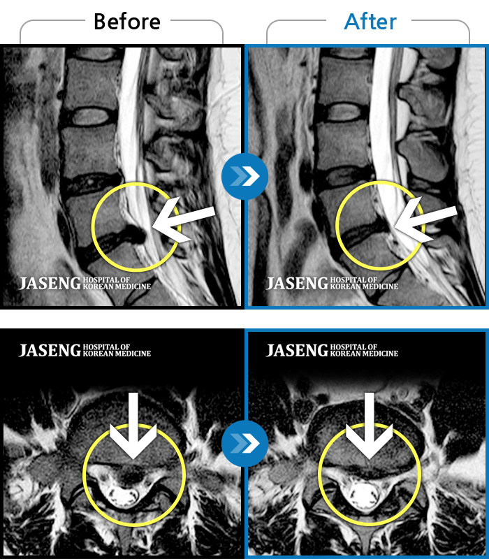 천안자생한방병원 치료 전후 MRI 비교 이미지