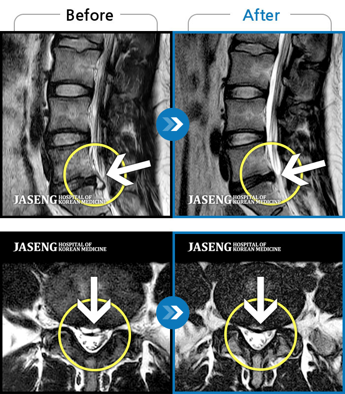 천안자생한방병원 치료 전후 MRI 비교 이미지