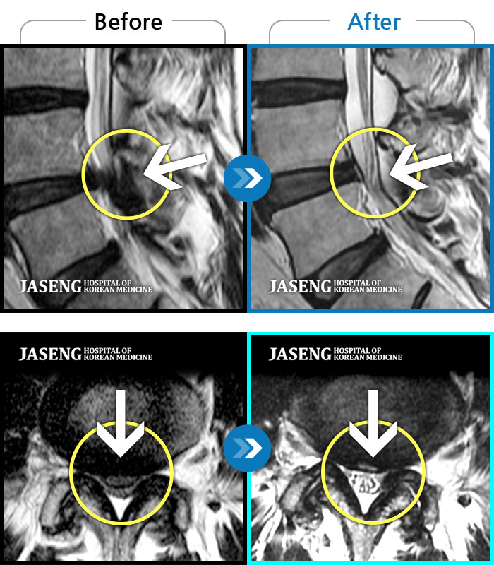해운대자생한방병원 치료 전후 MRI 비교 이미지