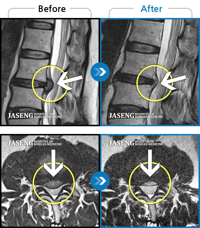 해운대자생한방병원 치료 전후 MRI 비교 이미지