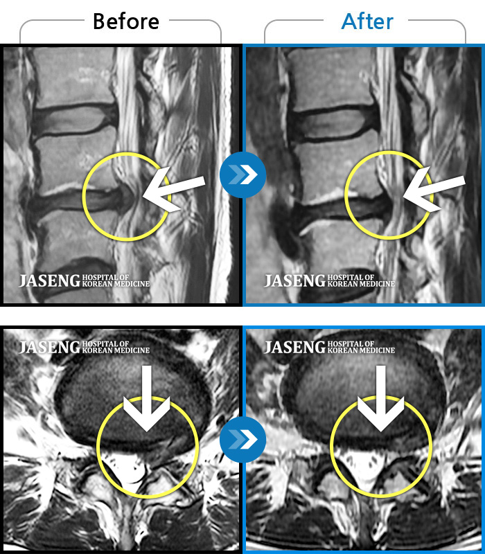 해운대자생한방병원 치료 전후 MRI 비교 이미지