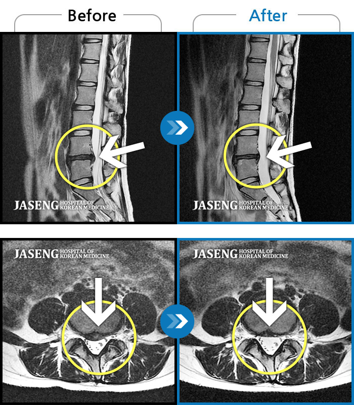수원자생한방병원 치료 전후 MRI 비교 이미지