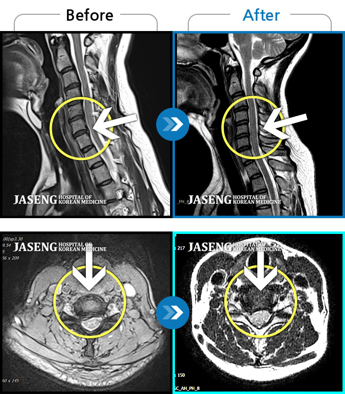 인천자생한방병원 치료 전후 MRI 비교 이미지