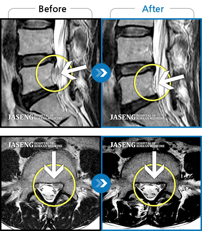 부천자생한방병원 치료 전후 MRI 비교 이미지