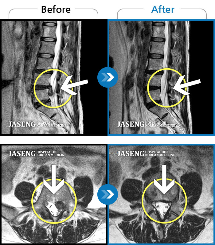 인천자생한방병원 치료 전후 MRI 비교 이미지