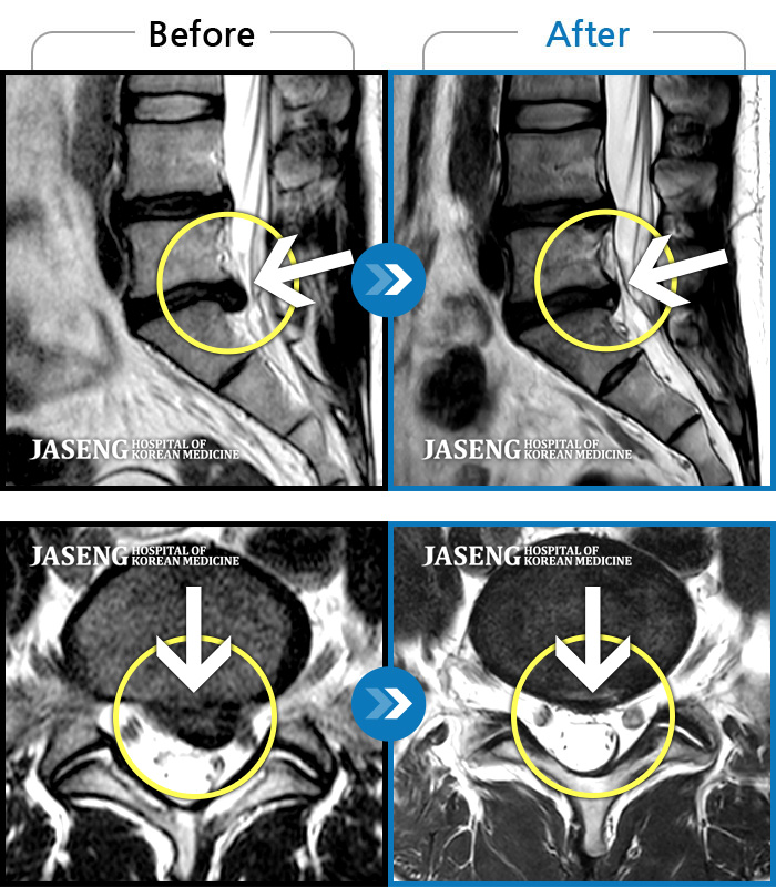 자생한방병원 치료 전후 MRI 비교 이미지